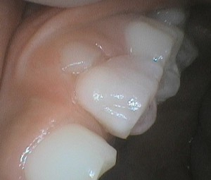 晩期残存臼歯